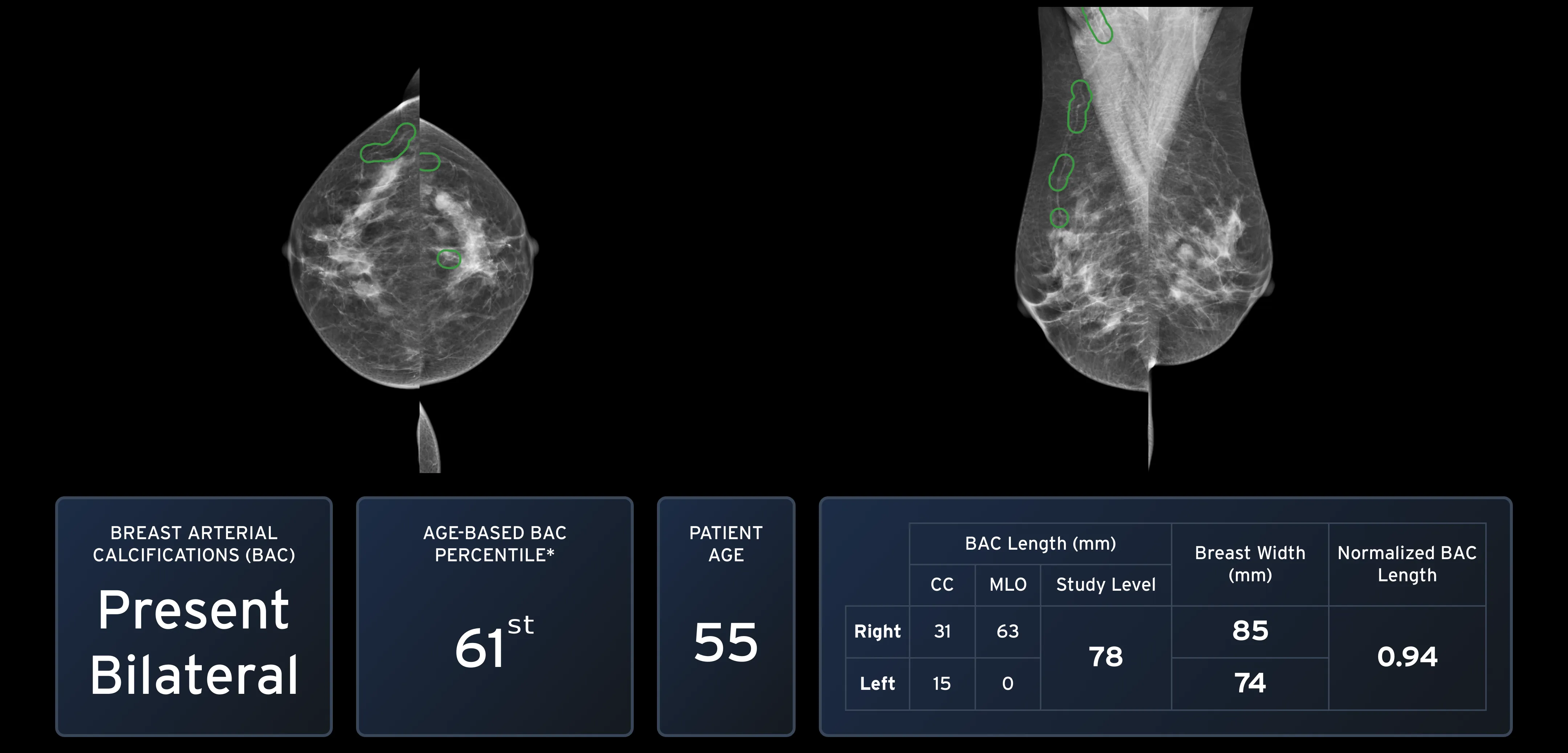 cmAngio ScoreCard showing BAC detection and localization results with markings on mammogram thumbnails