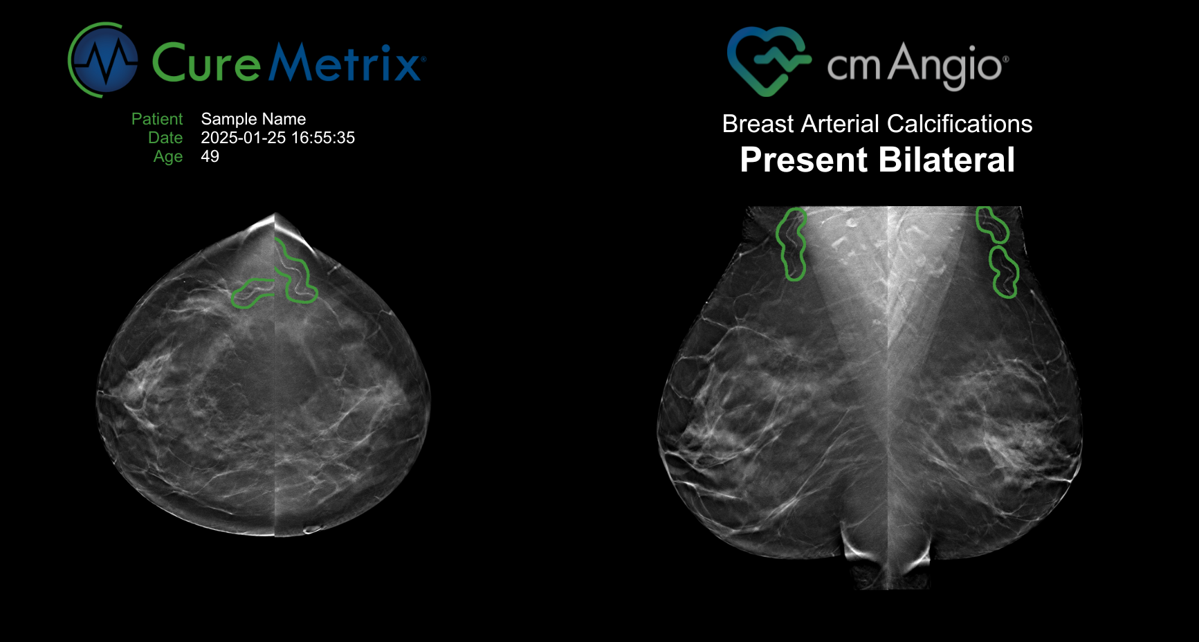 cmAngio ScoreCard showing BAC detection and localization results with markings on mammogram thumbnails