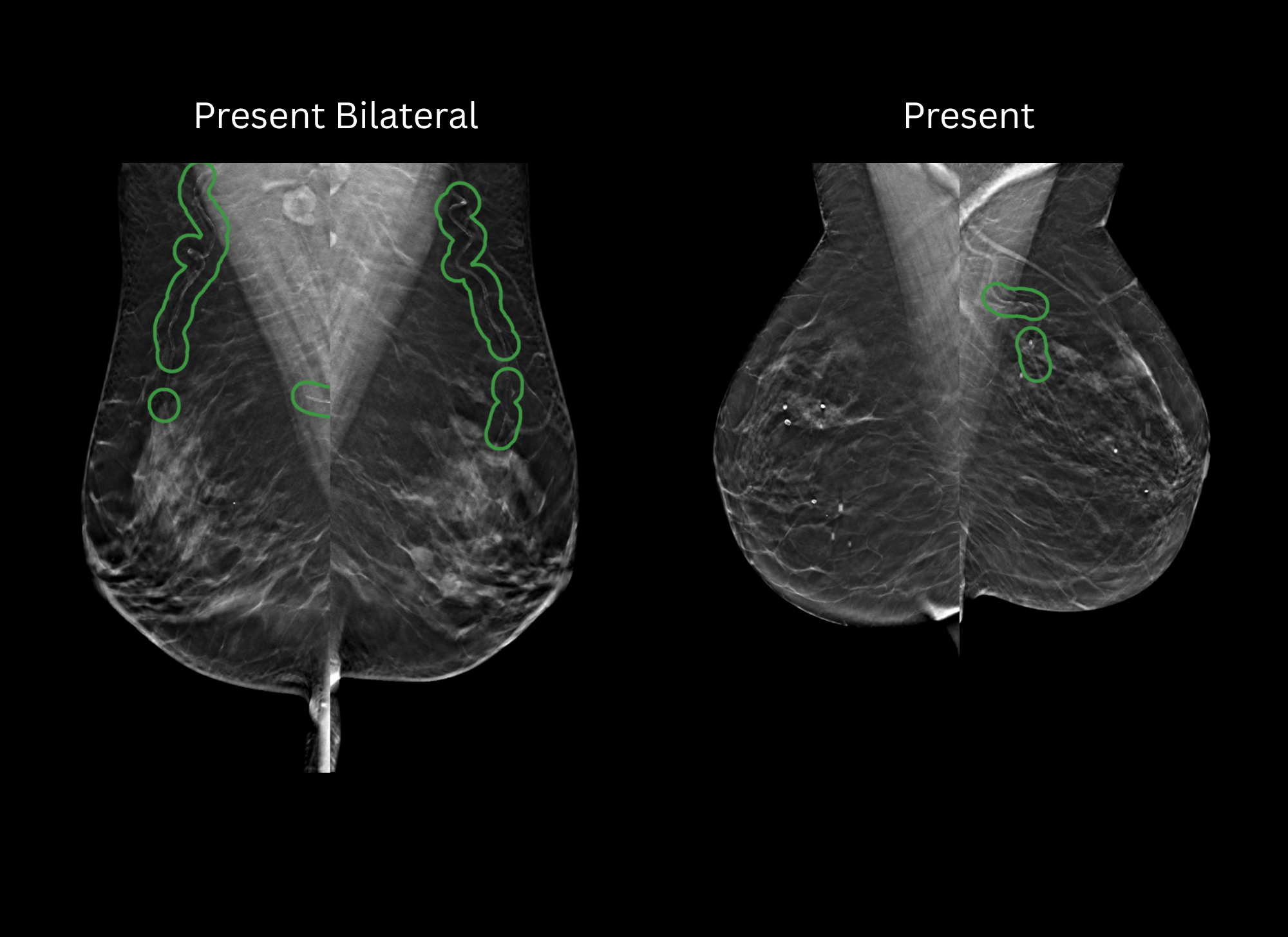 cmAngio Detect — BAC detection showing Present or Present Bilateral result on mammogram
